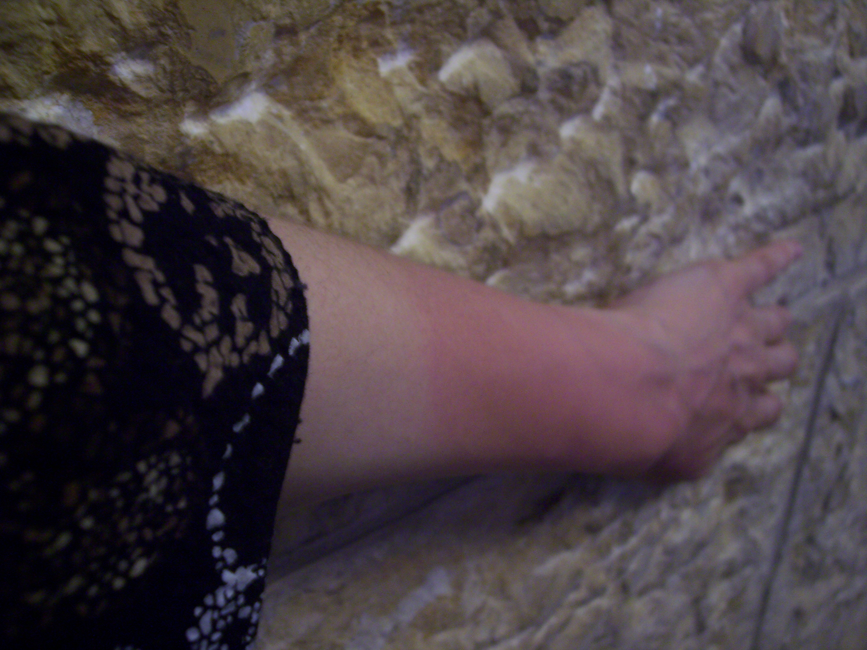 Burned_hand.JPG